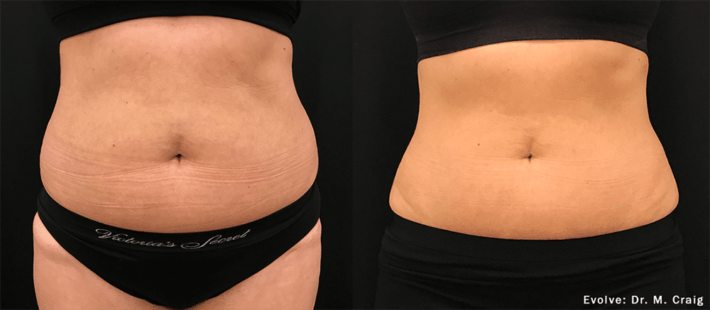 Cellulite: what is it and how can you get rid of it?